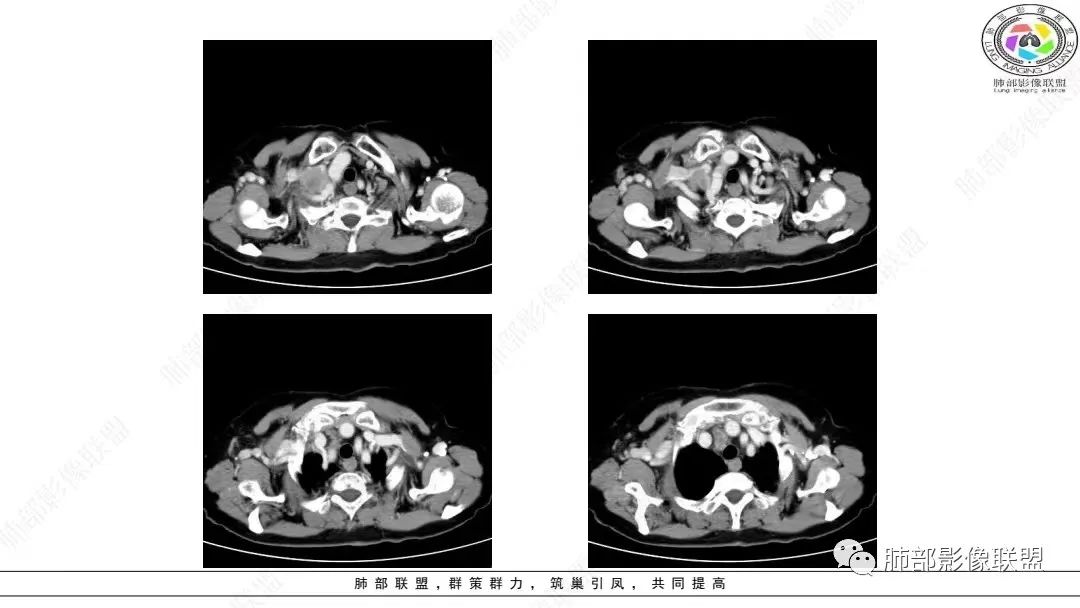 影像PPT - 【病例】肺淋巴上皮瘤样癌1例CT影像-29
