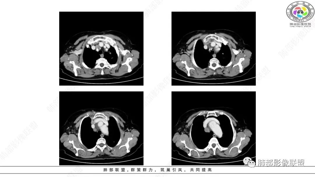 影像PPT - 【病例】肺淋巴上皮瘤样癌1例CT影像-30