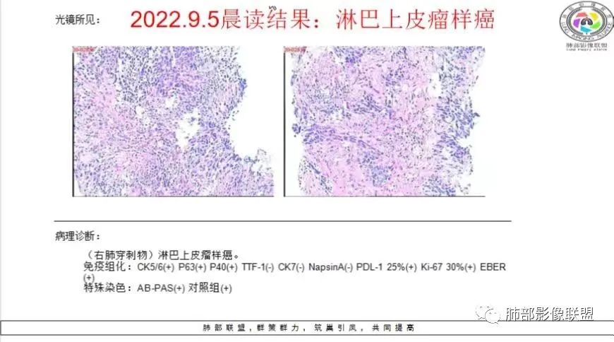 影像PPT - 【病例】肺淋巴上皮瘤样癌1例CT影像-41