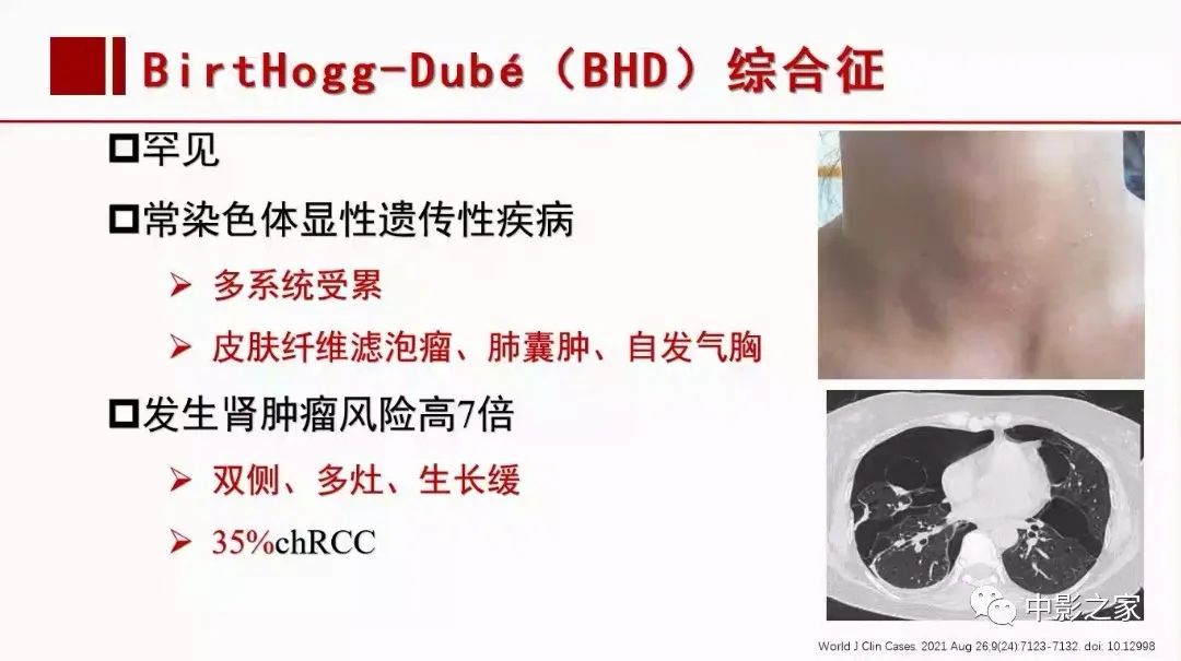 影像PPT - 【PPT】肾嫌色细胞癌影像诊断、鉴别、分级与预后评估-7