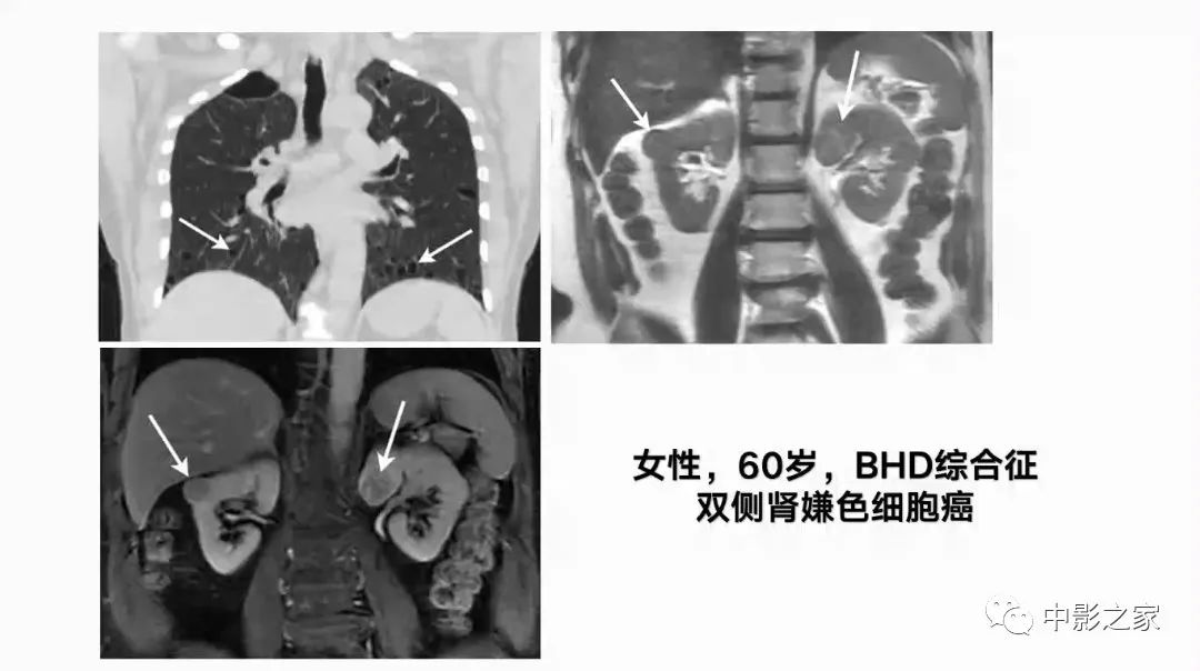影像PPT - 【PPT】肾嫌色细胞癌影像诊断、鉴别、分级与预后评估-8