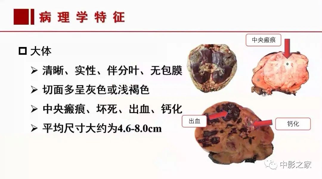 影像PPT - 【PPT】肾嫌色细胞癌影像诊断、鉴别、分级与预后评估-12