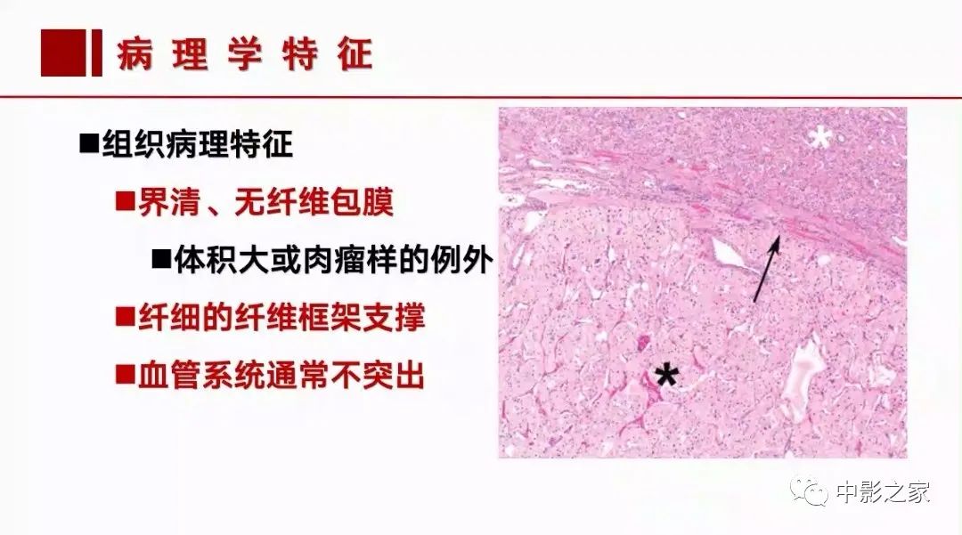 影像PPT - 【PPT】肾嫌色细胞癌影像诊断、鉴别、分级与预后评估-13