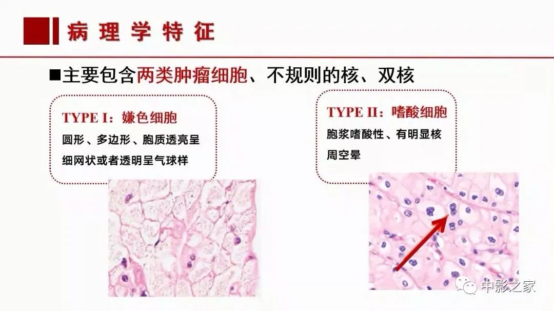 影像PPT - 【PPT】肾嫌色细胞癌影像诊断、鉴别、分级与预后评估-14