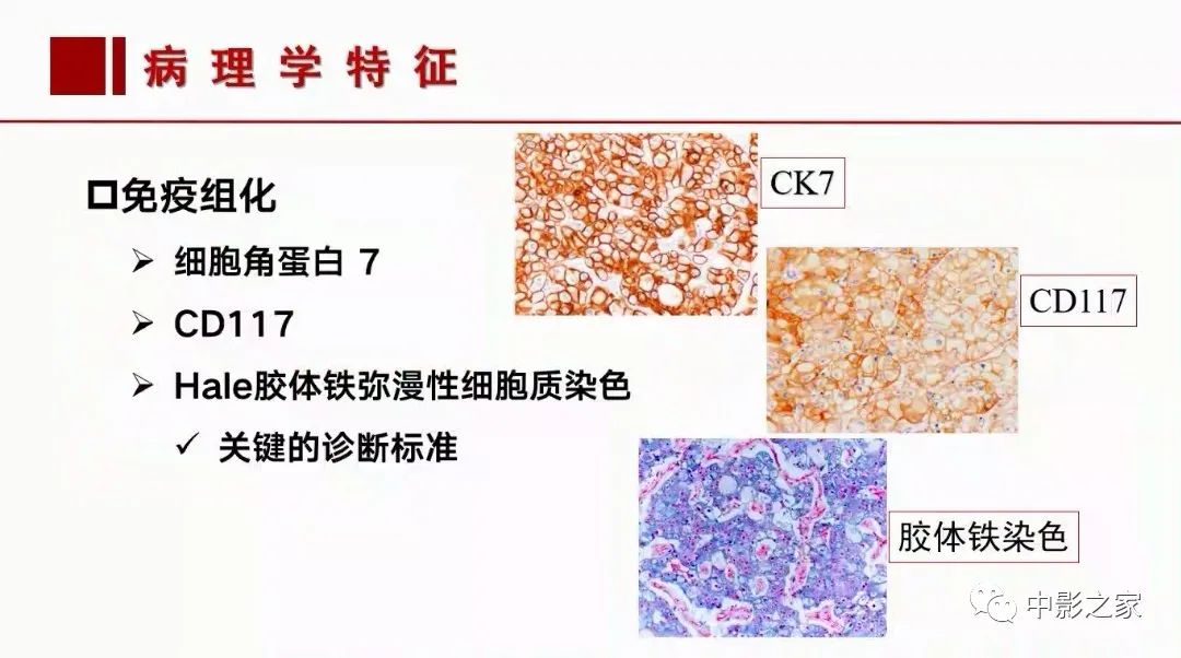 影像PPT - 【PPT】肾嫌色细胞癌影像诊断、鉴别、分级与预后评估-15