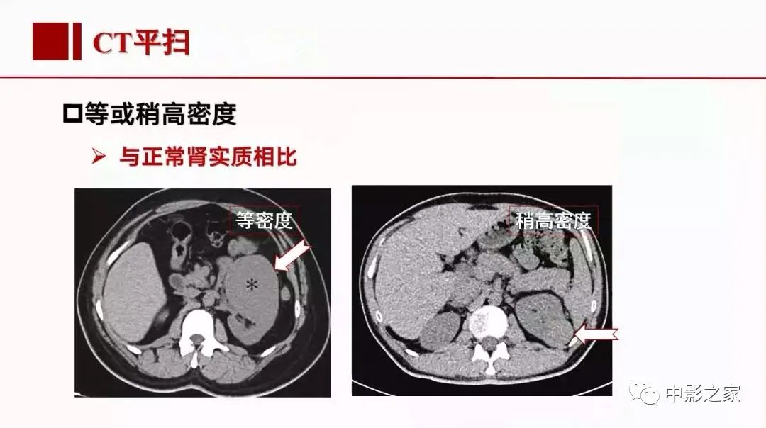 影像PPT - 【PPT】肾嫌色细胞癌影像诊断、鉴别、分级与预后评估-18
