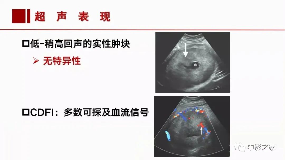 影像PPT - 【PPT】肾嫌色细胞癌影像诊断、鉴别、分级与预后评估-17