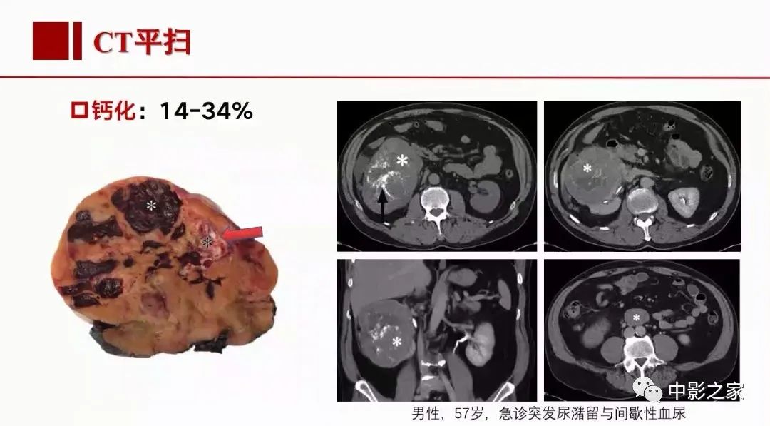 影像PPT - 【PPT】肾嫌色细胞癌影像诊断、鉴别、分级与预后评估-19