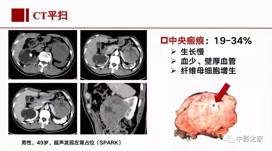 影像PPT - 【PPT】肾嫌色细胞癌影像诊断、鉴别、分级与预后评估-20