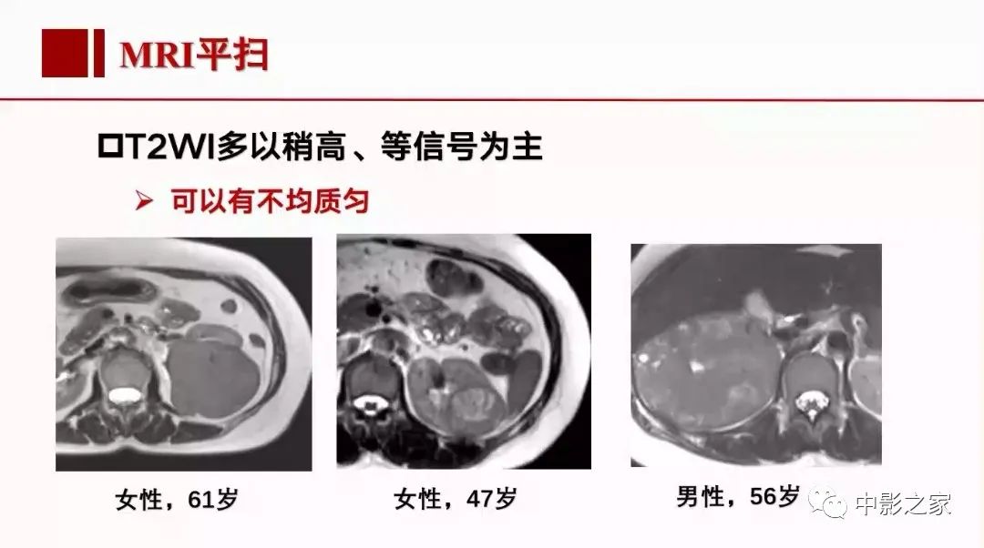 影像PPT - 【PPT】肾嫌色细胞癌影像诊断、鉴别、分级与预后评估-22