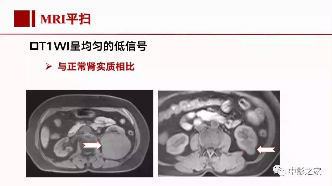 影像PPT - 【PPT】肾嫌色细胞癌影像诊断、鉴别、分级与预后评估-21