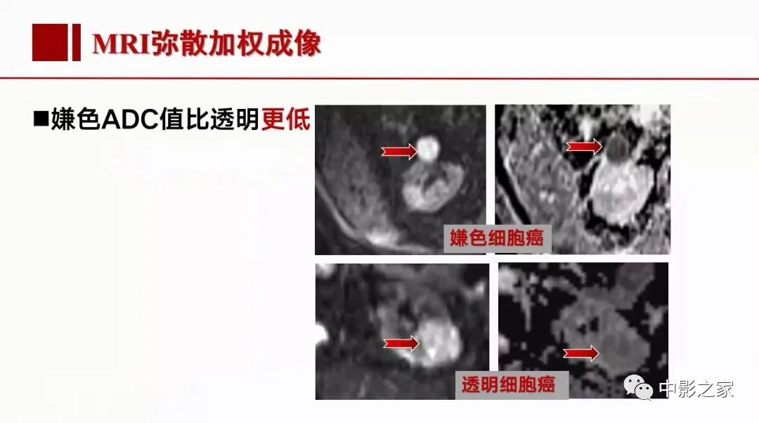 影像PPT - 【PPT】肾嫌色细胞癌影像诊断、鉴别、分级与预后评估-23
