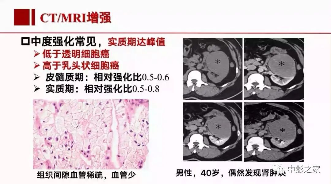影像PPT - 【PPT】肾嫌色细胞癌影像诊断、鉴别、分级与预后评估-24
