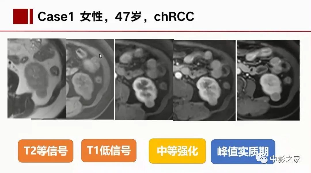 影像PPT - 【PPT】肾嫌色细胞癌影像诊断、鉴别、分级与预后评估-25