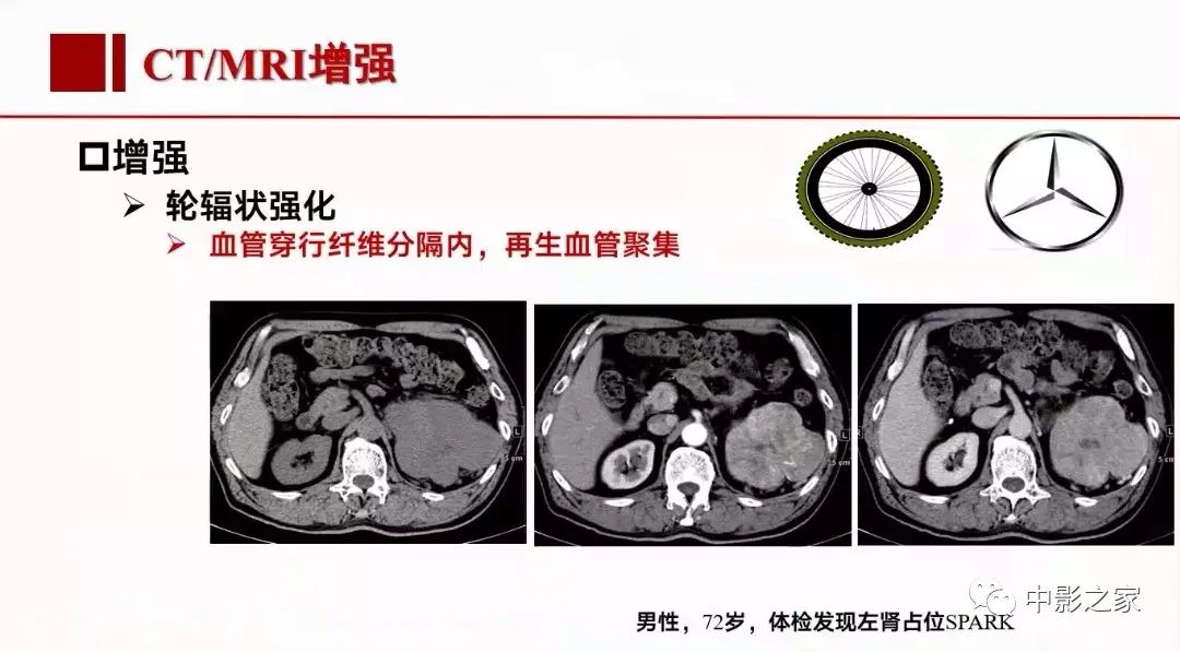 影像PPT - 【PPT】肾嫌色细胞癌影像诊断、鉴别、分级与预后评估-26