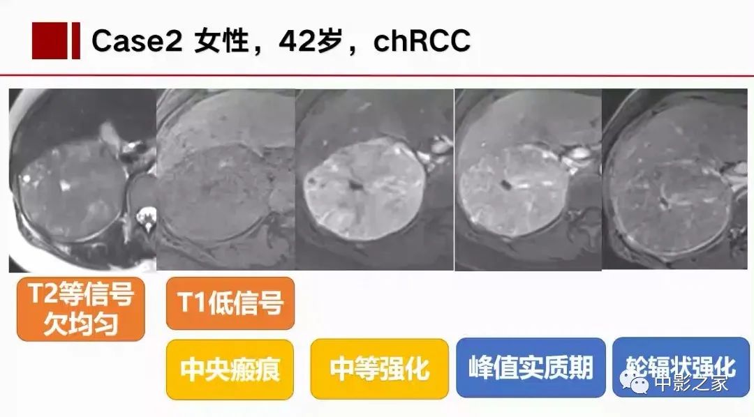 影像PPT - 【PPT】肾嫌色细胞癌影像诊断、鉴别、分级与预后评估-27