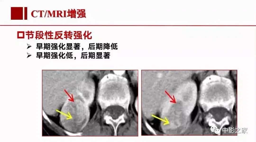 影像PPT - 【PPT】肾嫌色细胞癌影像诊断、鉴别、分级与预后评估-28