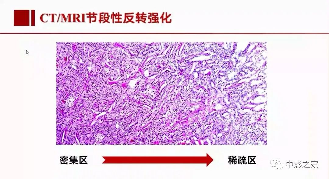 影像PPT - 【PPT】肾嫌色细胞癌影像诊断、鉴别、分级与预后评估-29