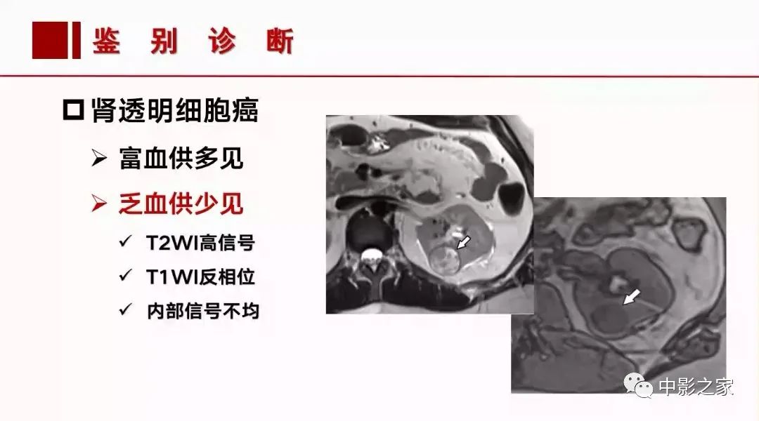 影像PPT - 【PPT】肾嫌色细胞癌影像诊断、鉴别、分级与预后评估-32