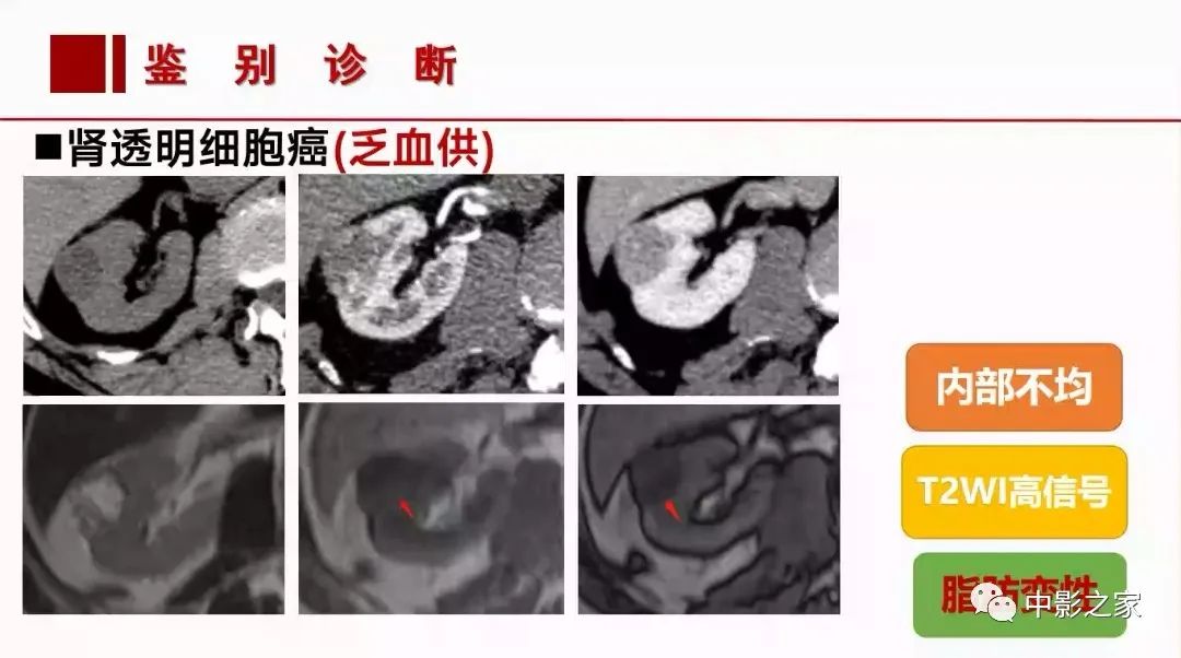 影像PPT - 【PPT】肾嫌色细胞癌影像诊断、鉴别、分级与预后评估-33