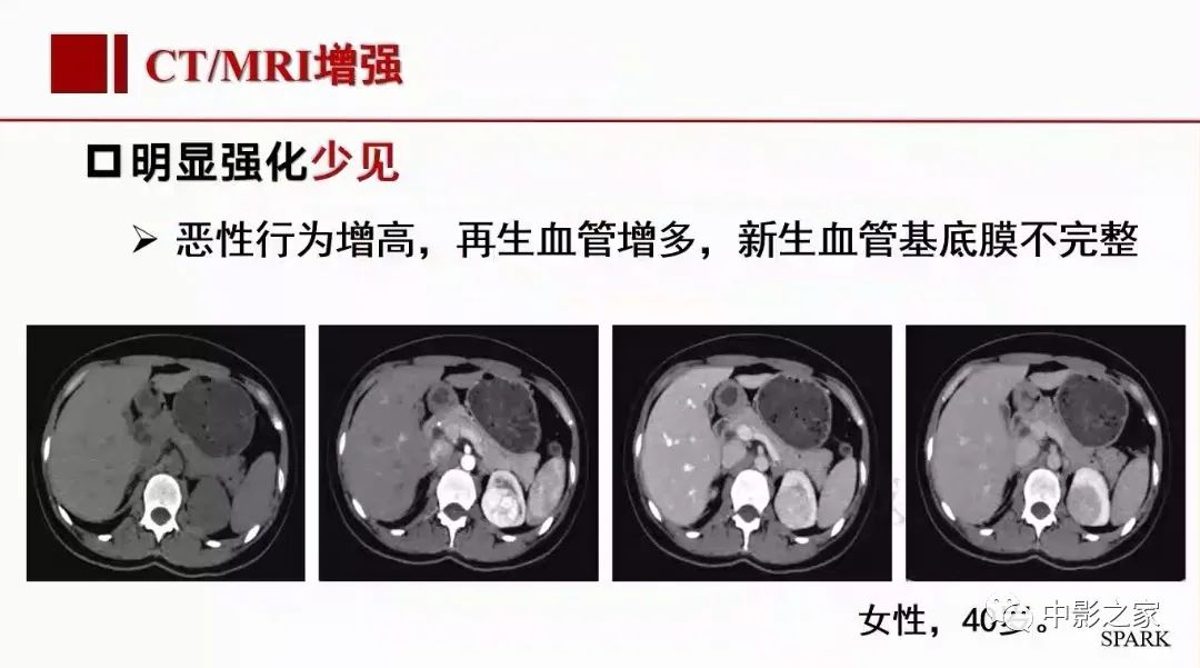 影像PPT - 【PPT】肾嫌色细胞癌影像诊断、鉴别、分级与预后评估-30