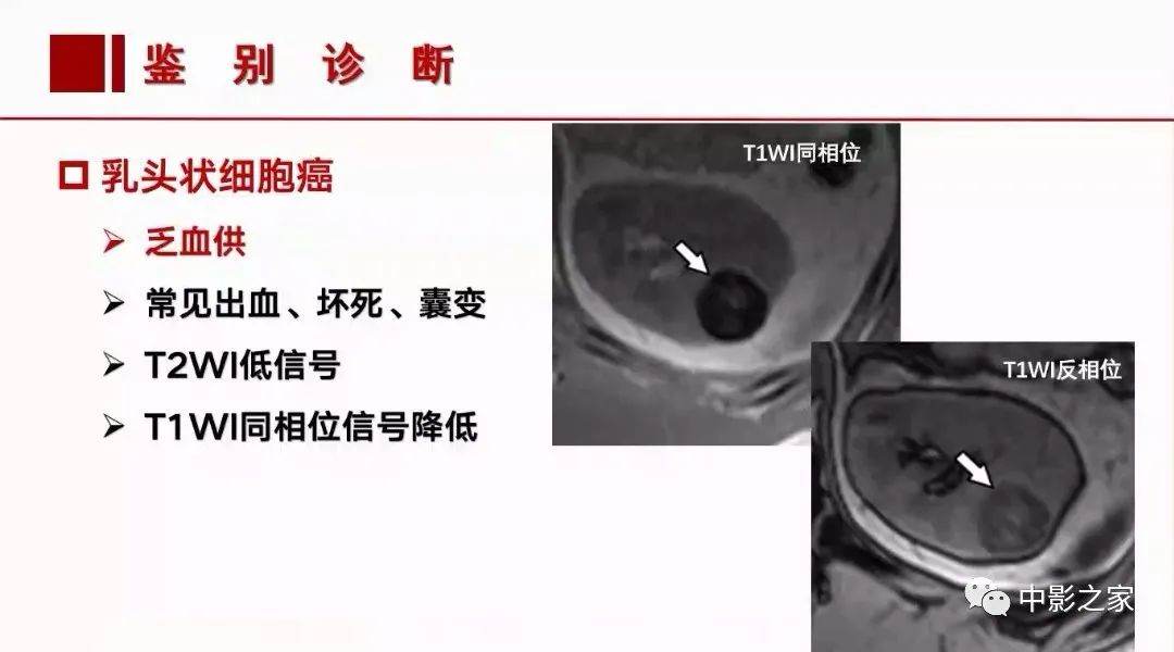 影像PPT - 【PPT】肾嫌色细胞癌影像诊断、鉴别、分级与预后评估-34