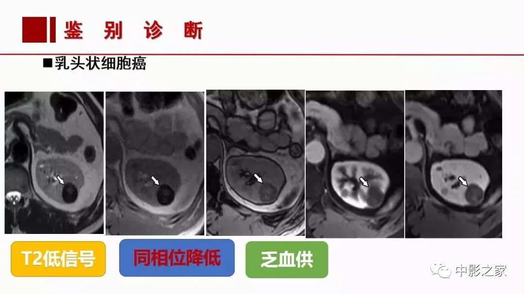 影像PPT - 【PPT】肾嫌色细胞癌影像诊断、鉴别、分级与预后评估-35