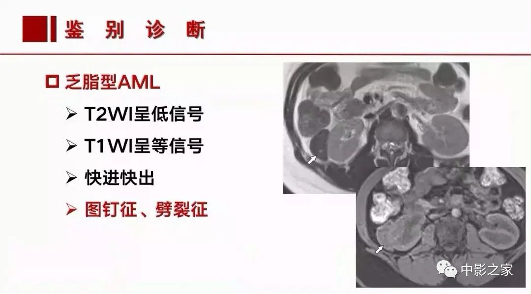 影像PPT - 【PPT】肾嫌色细胞癌影像诊断、鉴别、分级与预后评估-36