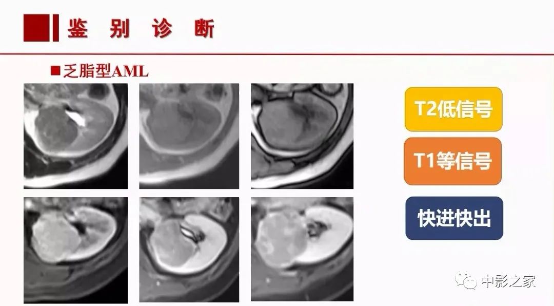 影像PPT - 【PPT】肾嫌色细胞癌影像诊断、鉴别、分级与预后评估-37