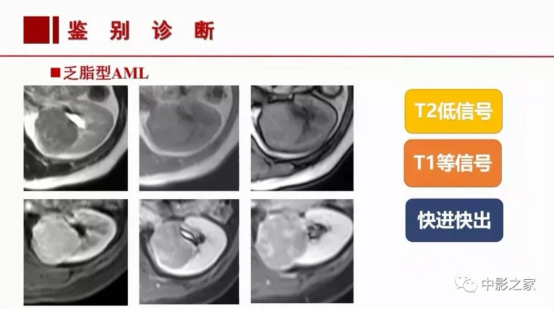 影像PPT - 【PPT】肾嫌色细胞癌影像诊断、鉴别、分级与预后评估-38