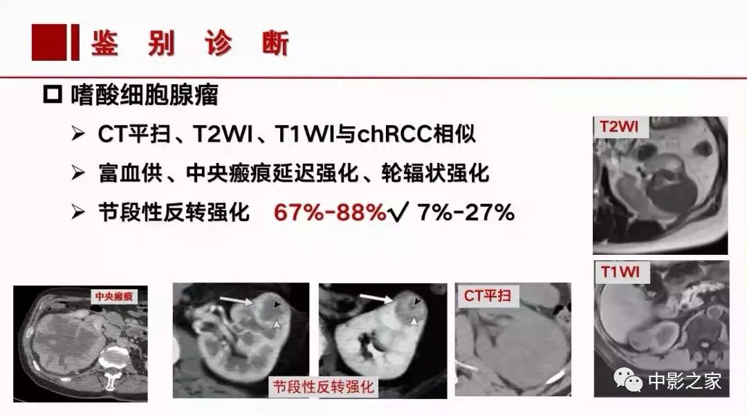 影像PPT - 【PPT】肾嫌色细胞癌影像诊断、鉴别、分级与预后评估-39