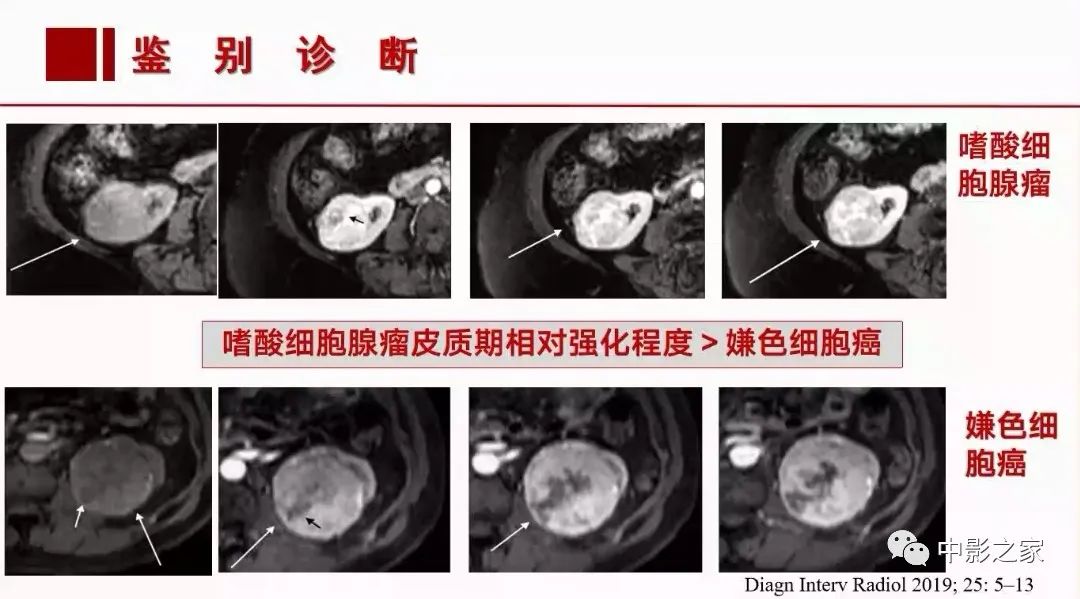 影像PPT - 【PPT】肾嫌色细胞癌影像诊断、鉴别、分级与预后评估-40