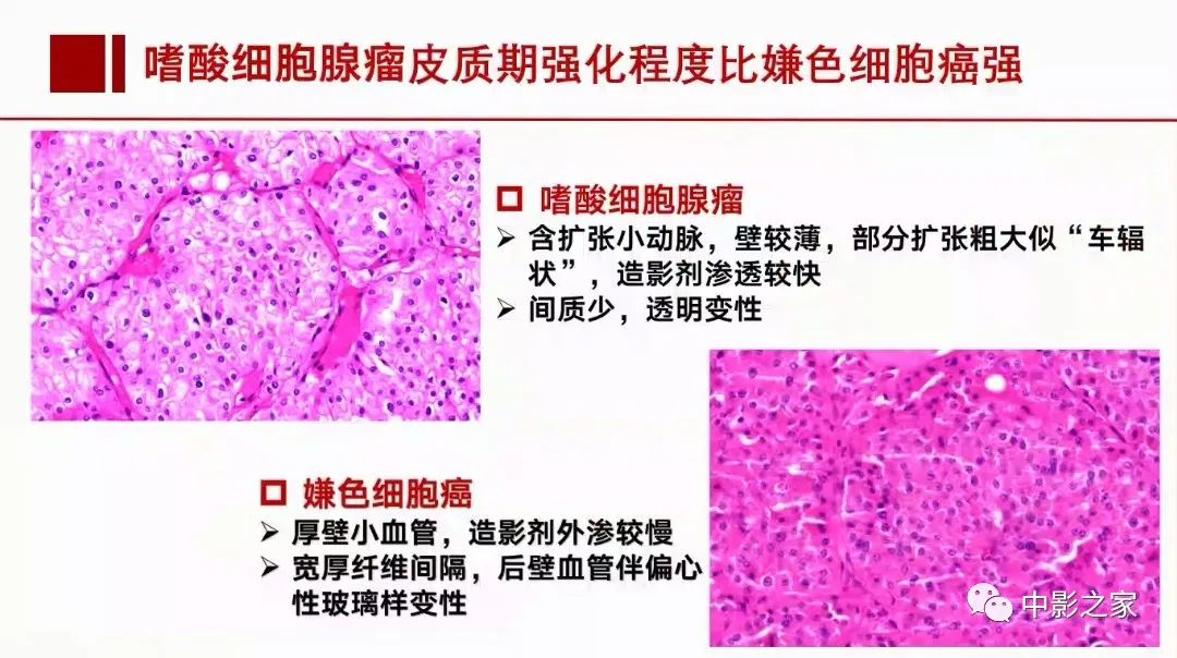 影像PPT - 【PPT】肾嫌色细胞癌影像诊断、鉴别、分级与预后评估-41