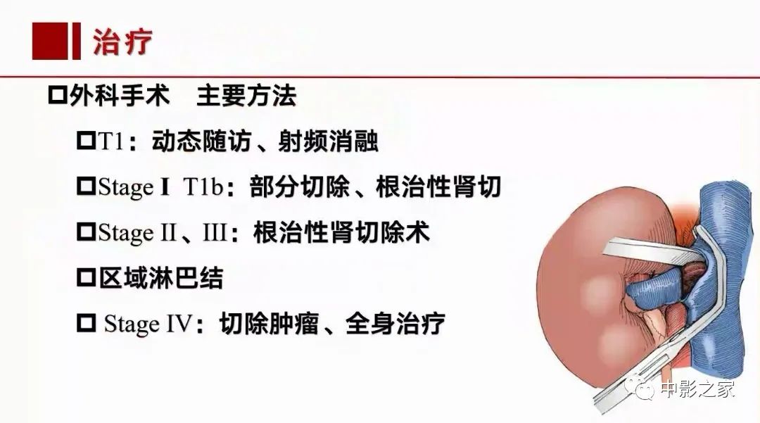 影像PPT - 【PPT】肾嫌色细胞癌影像诊断、鉴别、分级与预后评估-48