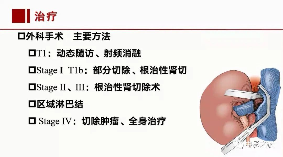影像PPT - 【PPT】肾嫌色细胞癌影像诊断、鉴别、分级与预后评估-50