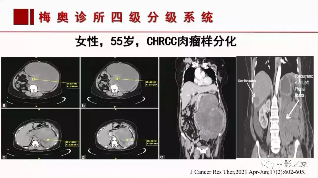 影像PPT - 【PPT】肾嫌色细胞癌影像诊断、鉴别、分级与预后评估-54