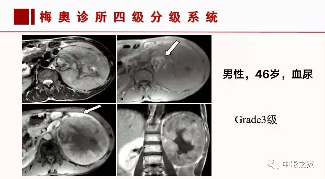 影像PPT - 【PPT】肾嫌色细胞癌影像诊断、鉴别、分级与预后评估-55