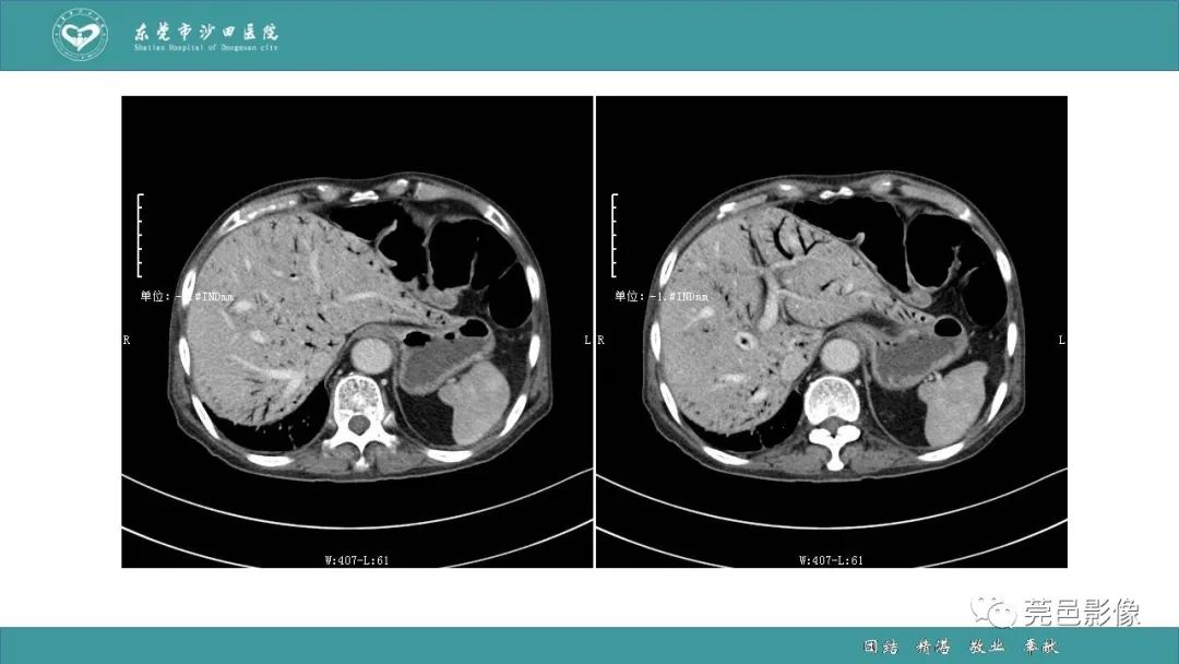 影像PPT - 【PPT】1例肠缺血坏死伴门静脉积气的CT诊断-5