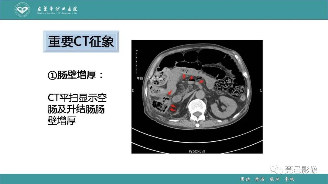 影像PPT - 【PPT】1例肠缺血坏死伴门静脉积气的CT诊断-26