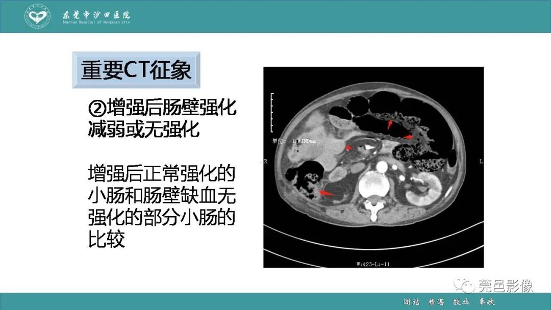 影像PPT - 【PPT】1例肠缺血坏死伴门静脉积气的CT诊断-27