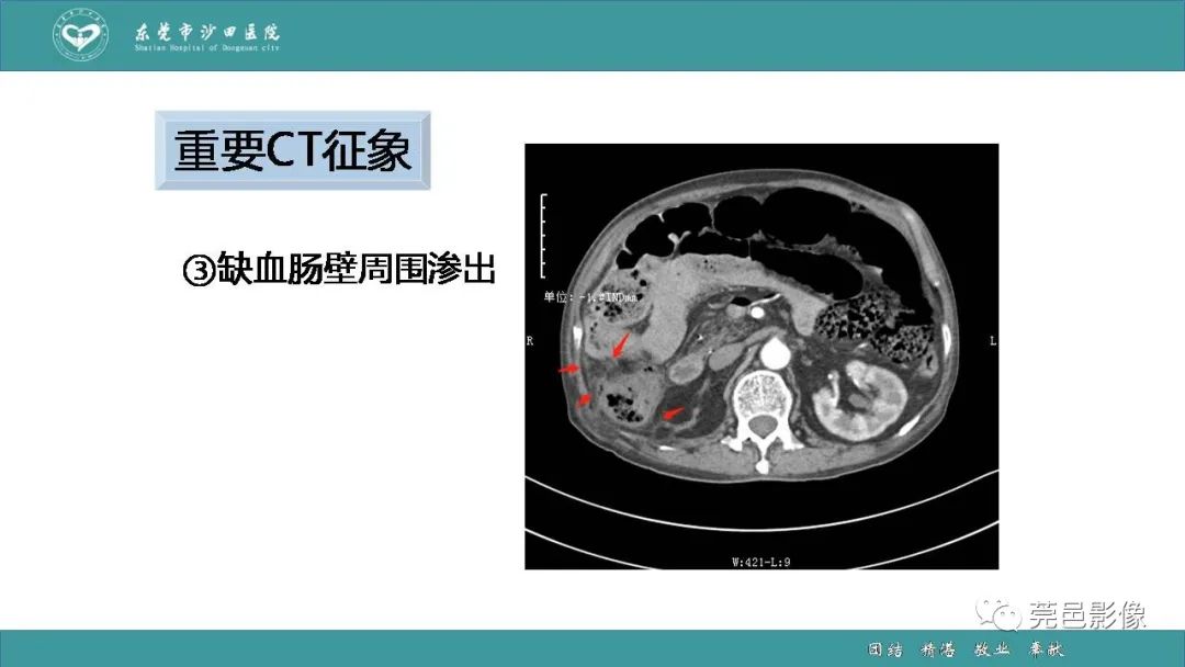 影像PPT - 【PPT】1例肠缺血坏死伴门静脉积气的CT诊断-28