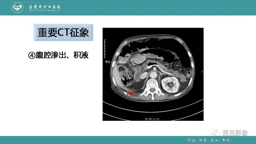 影像PPT - 【PPT】1例肠缺血坏死伴门静脉积气的CT诊断-29