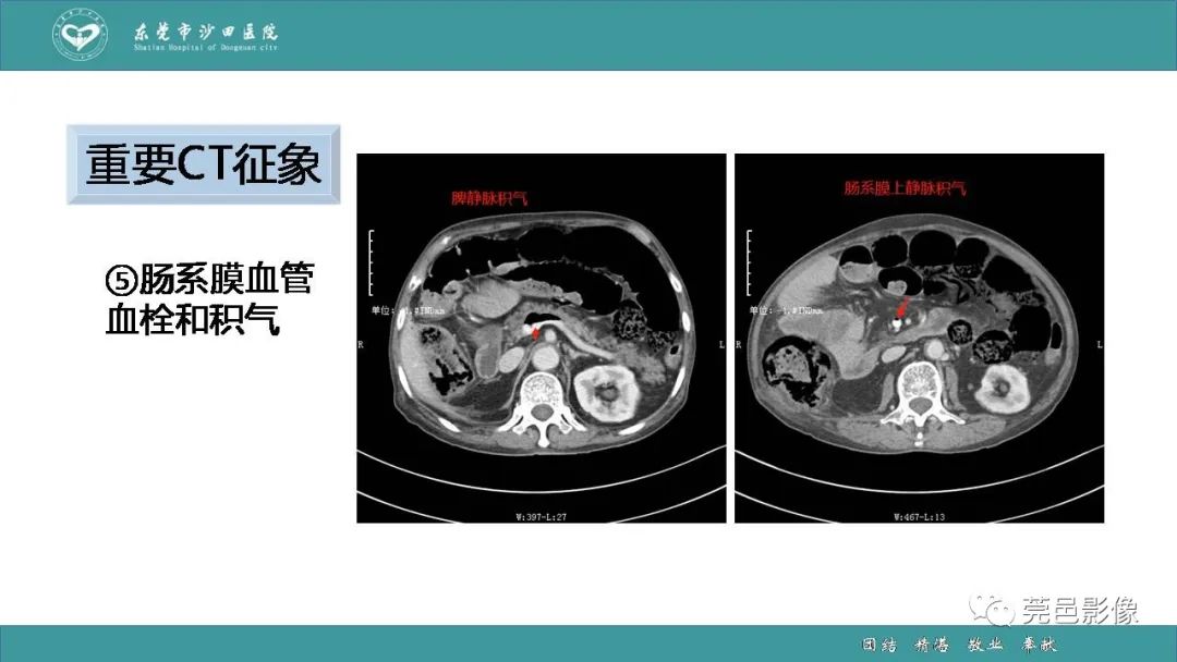 影像PPT - 【PPT】1例肠缺血坏死伴门静脉积气的CT诊断-30