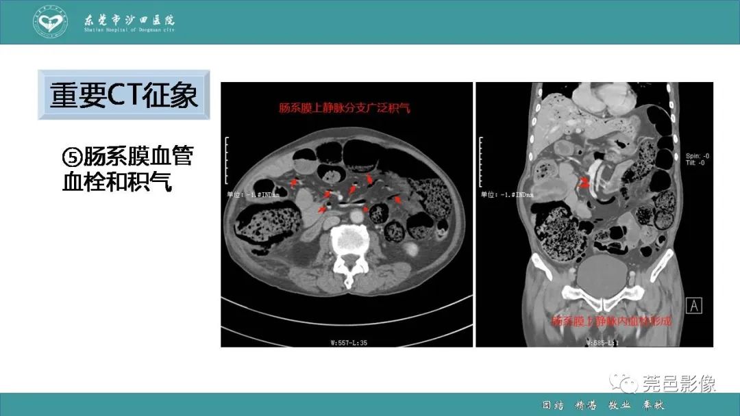 影像PPT - 【PPT】1例肠缺血坏死伴门静脉积气的CT诊断-31