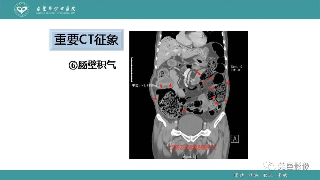 影像PPT - 【PPT】1例肠缺血坏死伴门静脉积气的CT诊断-32