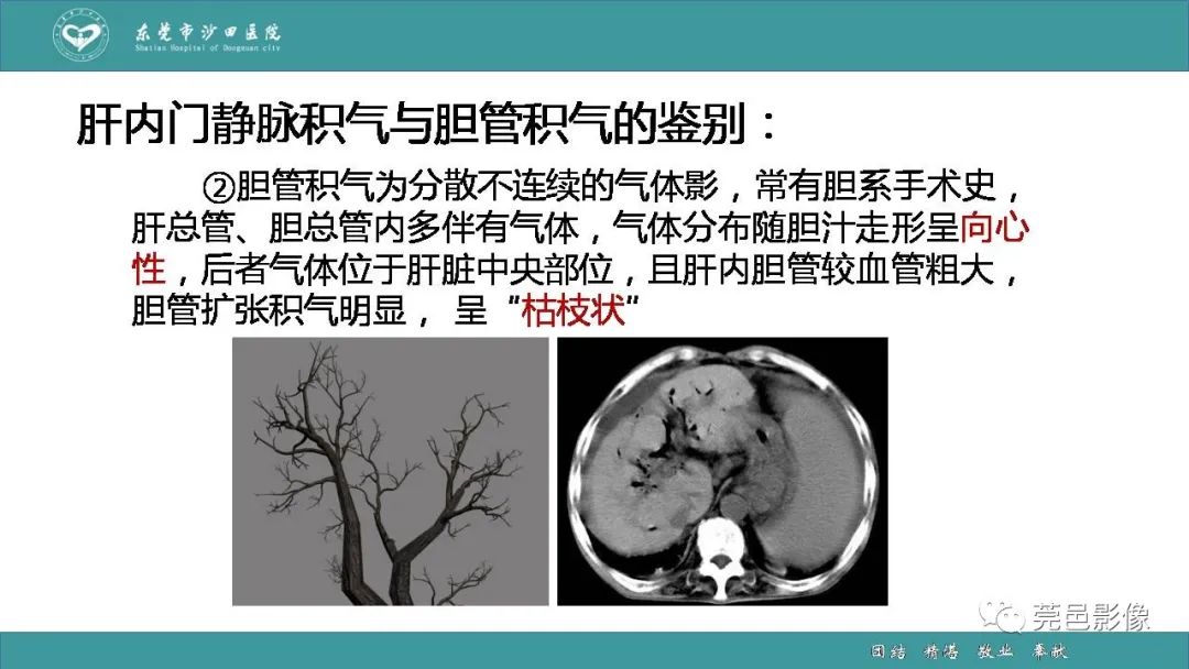 影像PPT - 【PPT】1例肠缺血坏死伴门静脉积气的CT诊断-35