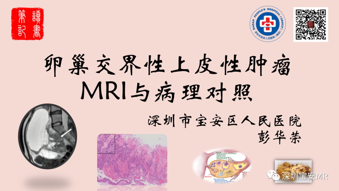 影像PPT - 【PPT】卵巢交界性上皮性肿瘤MRI与病理对照-1