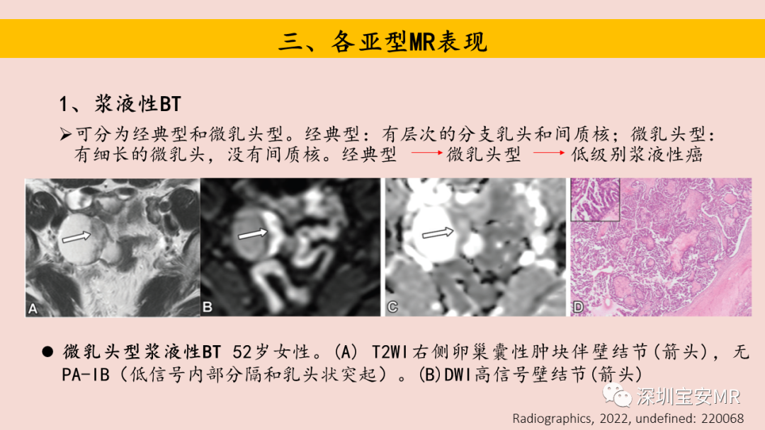 影像PPT - 【PPT】卵巢交界性上皮性肿瘤MRI与病理对照-19