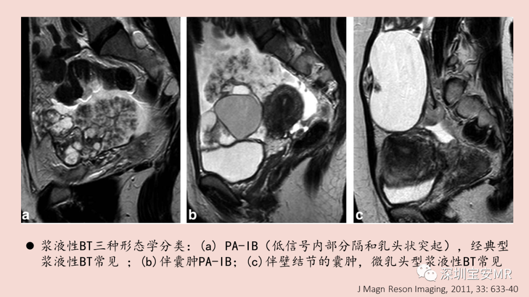 影像PPT - 【PPT】卵巢交界性上皮性肿瘤MRI与病理对照-21