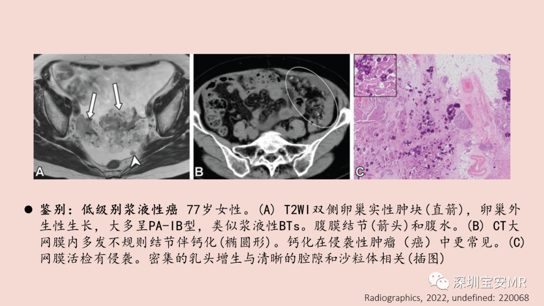 影像PPT - 【PPT】卵巢交界性上皮性肿瘤MRI与病理对照-23